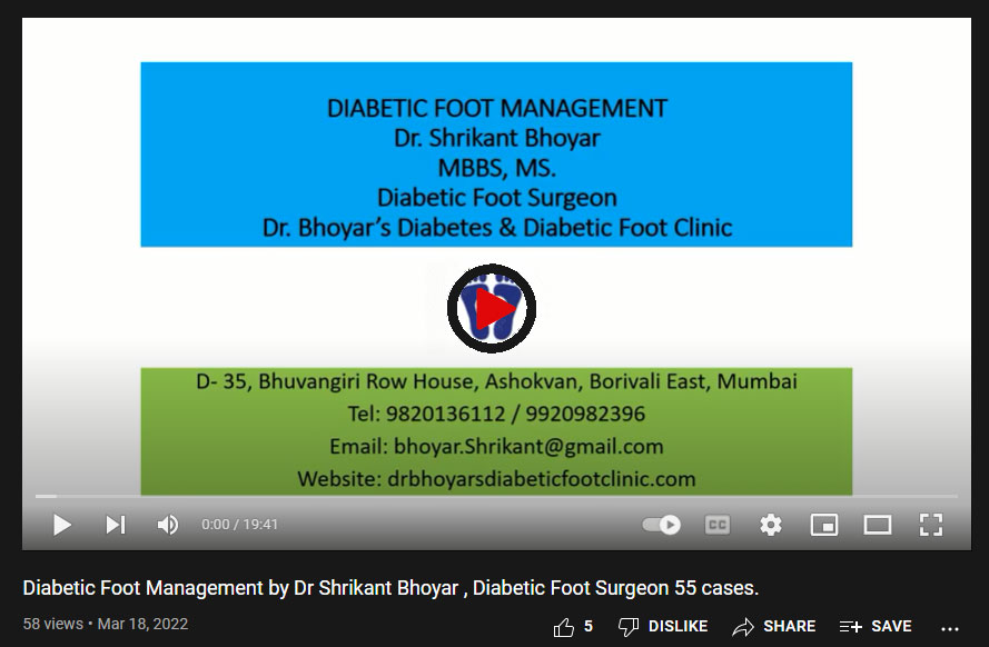 Diabetic Foot Management by Dr Shrikant Bhoyar , Diabetic Foot Surgeon 55 cases