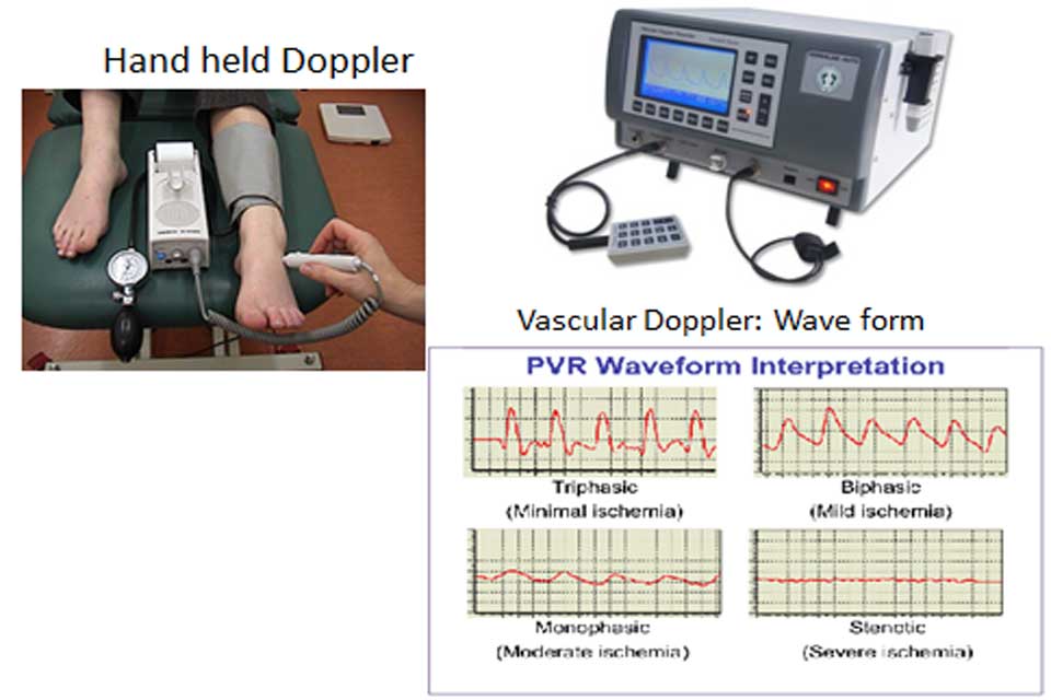 Vascular Assessment by Doppler and ABI Index
