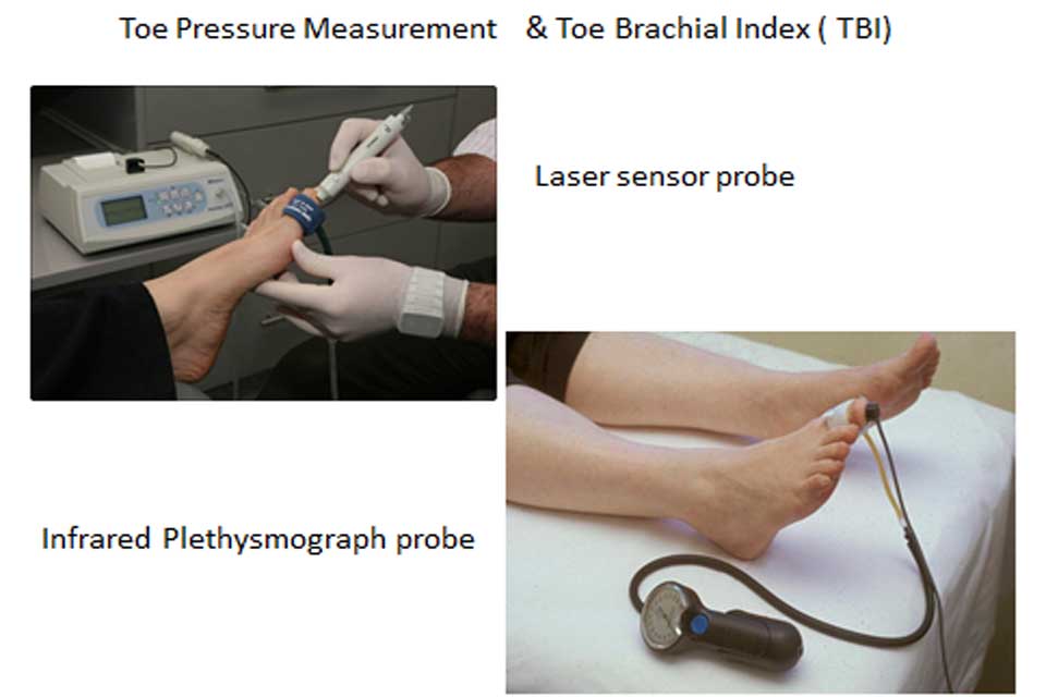 Toe Pressure Measurement and TBI Index Measurement